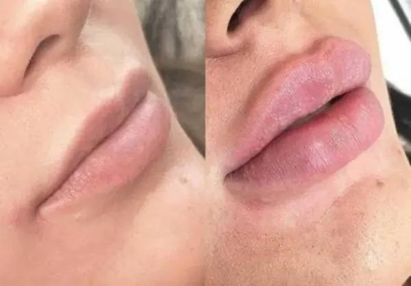 Lips before (left) and after (right) dermal filler